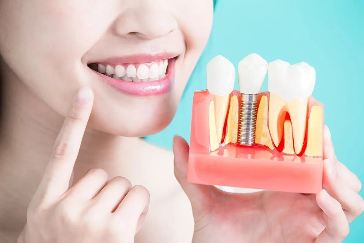 Are Dental Implants Safe? Understanding the Risks and Long-Term Effects